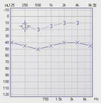 一分钟教你看懂耳朵听力检查报告