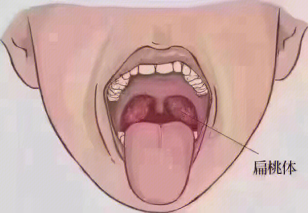 腭扁桃体肿大分度图片