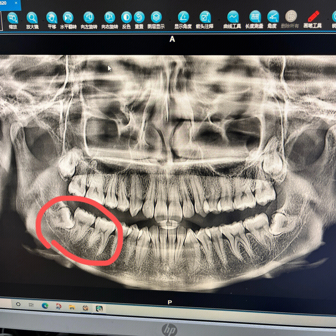 拔牙后恢复过程图图片