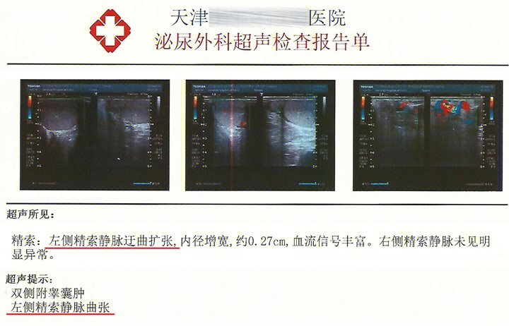 精索静脉曲张外观自测图片