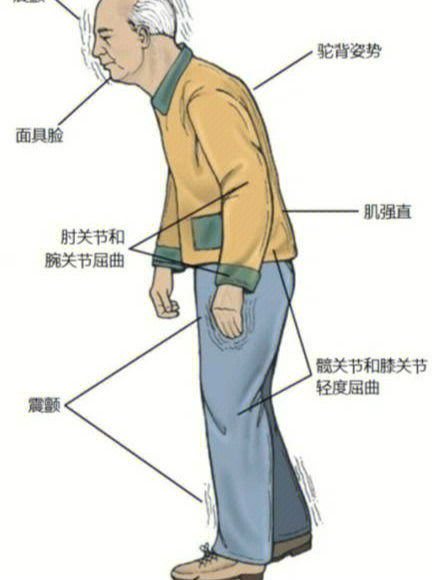 帕金森这些症状你有吗