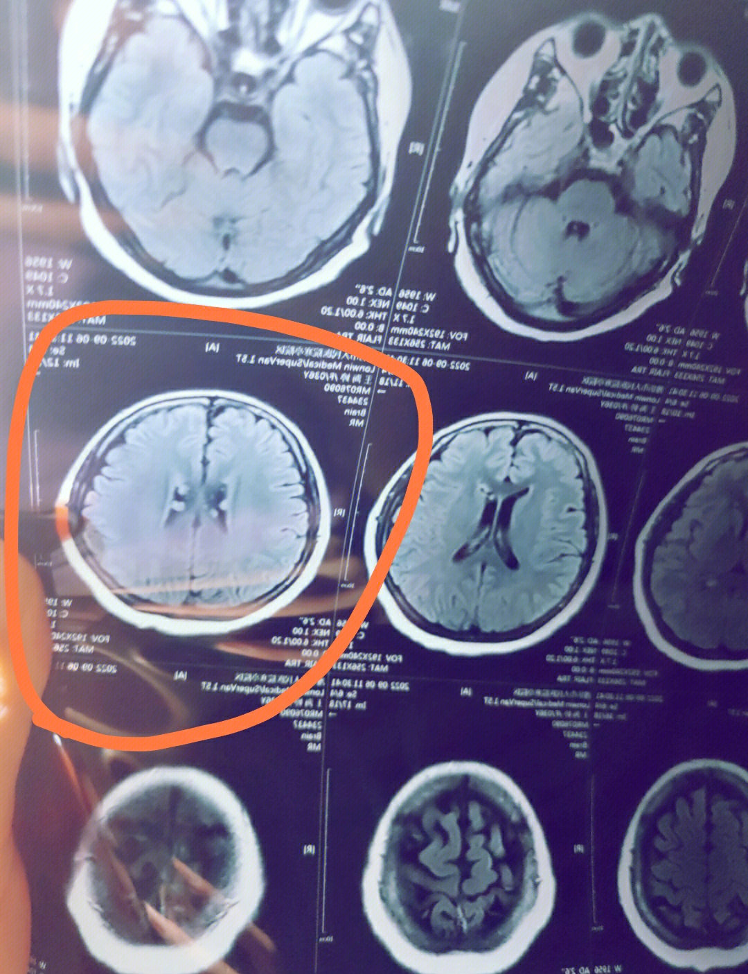 脑部核磁共振哪位老师可以给看下片子