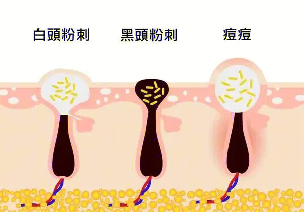 闭口类型图解图片