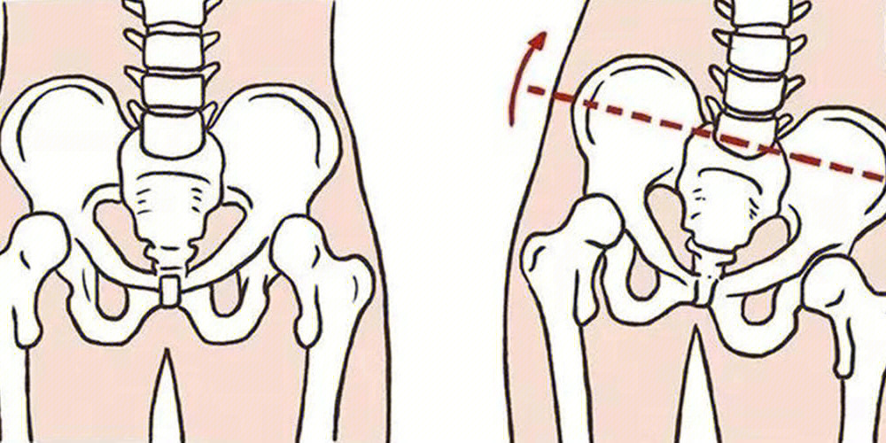骨盆前后倾斜图片