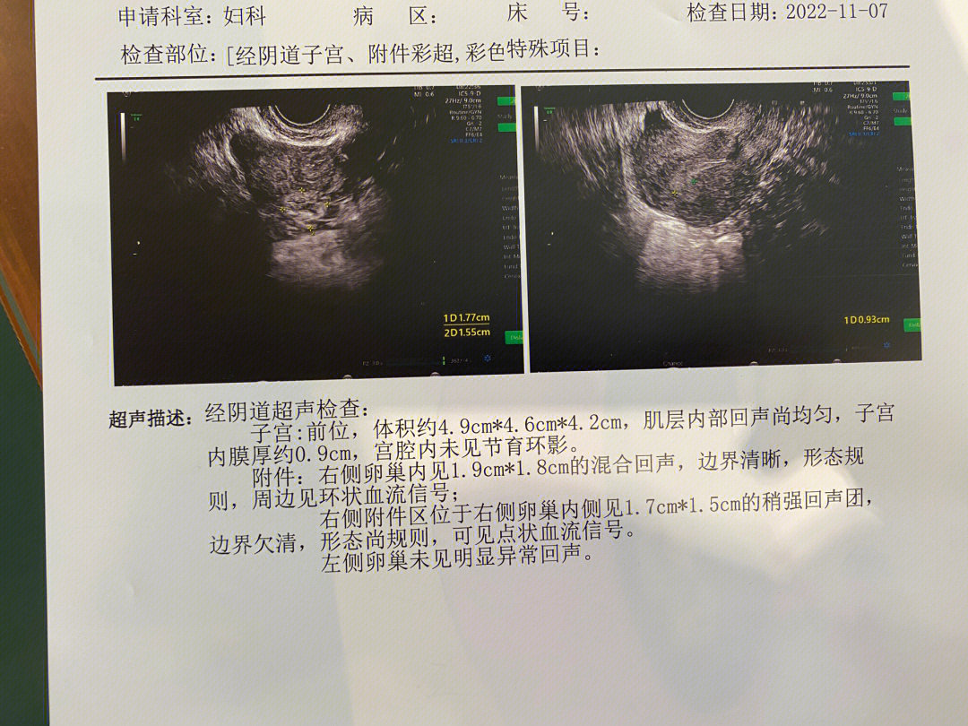 疑似宫外孕翻盘