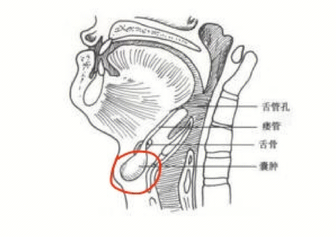 甲状舌管囊肿