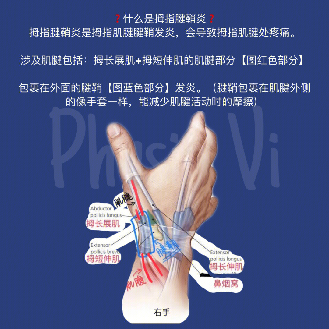 大拇指腱鞘炎症状图图片