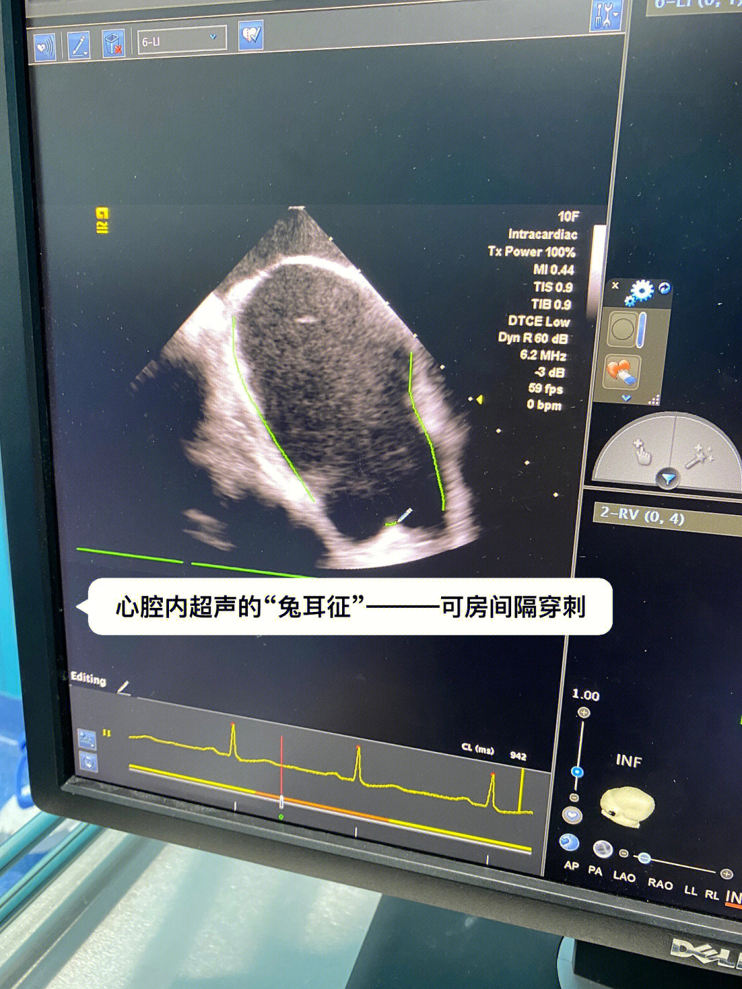 以实现心脏解剖结构,心脏血流动力学,心脏功能等信息的实时成