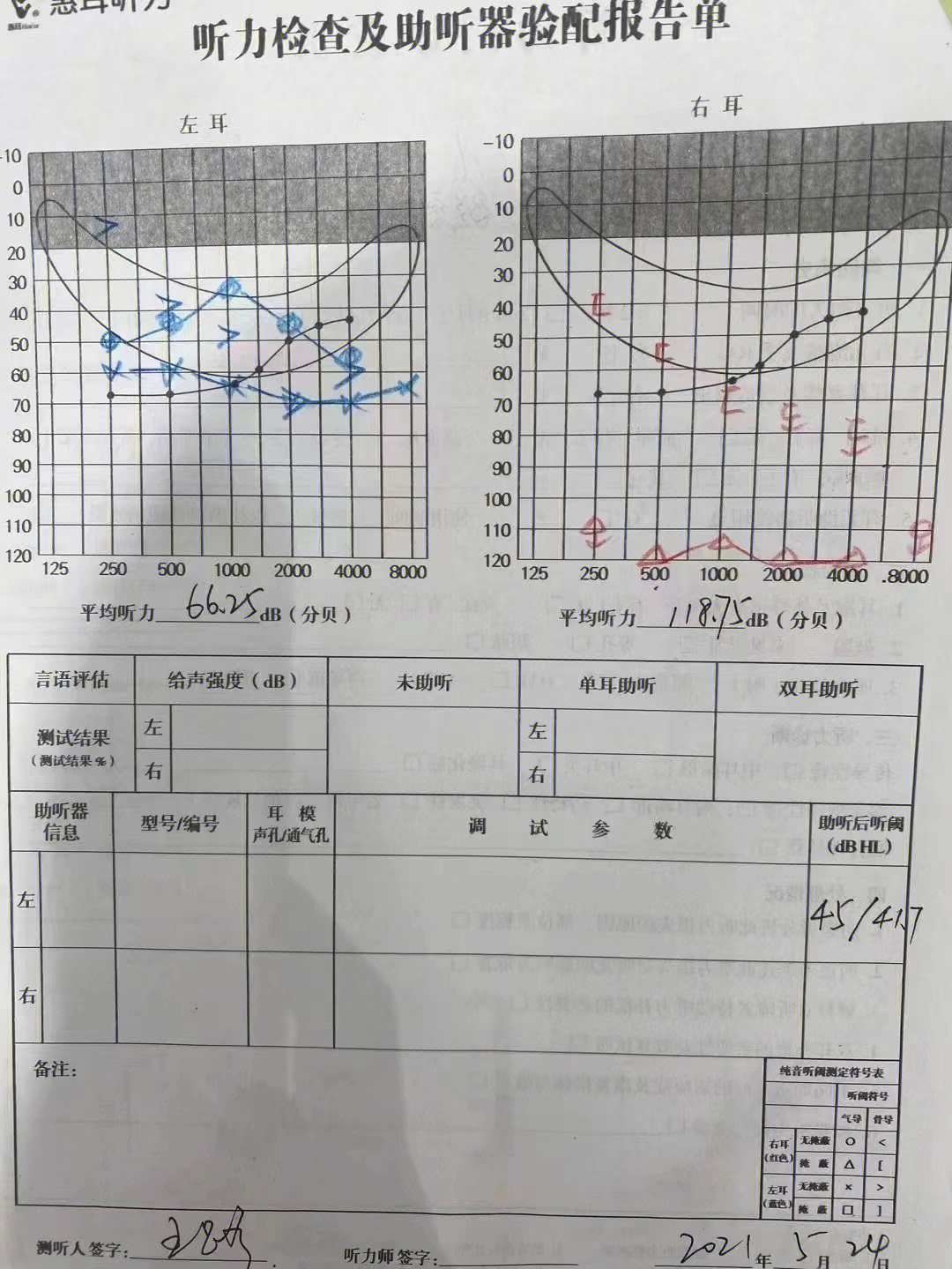 从内蒙来的娃 2021年5月右耳突发听力下降,抱着试一试的心态来