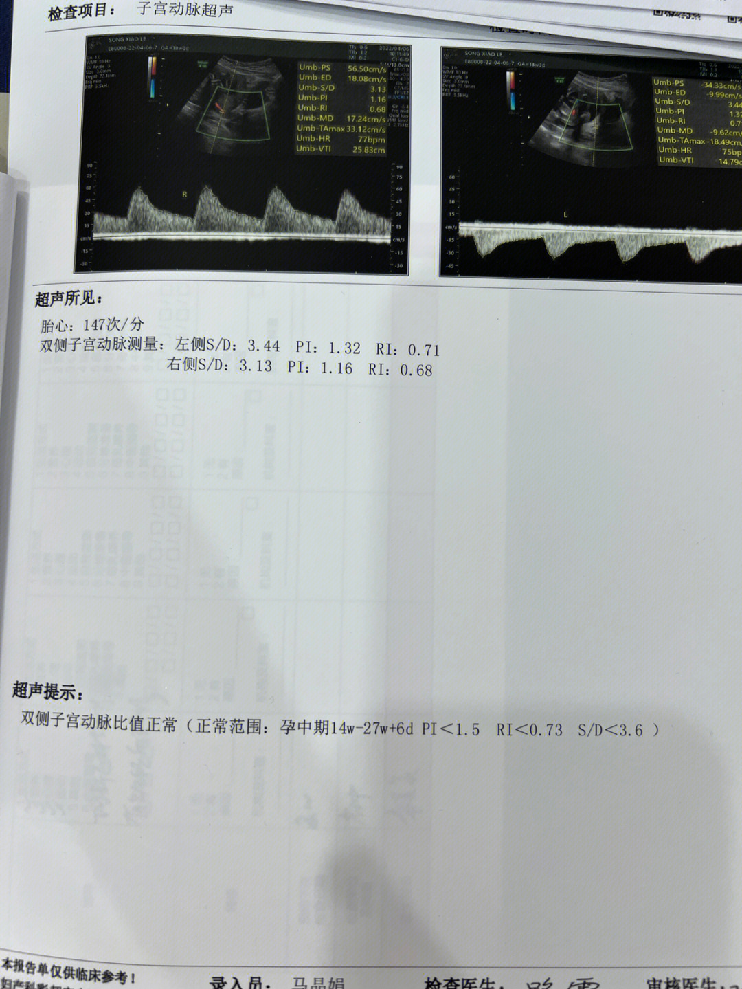 子宫动脉和d2聚体