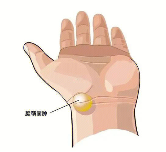 手腕腱鞘囊肿根治图片