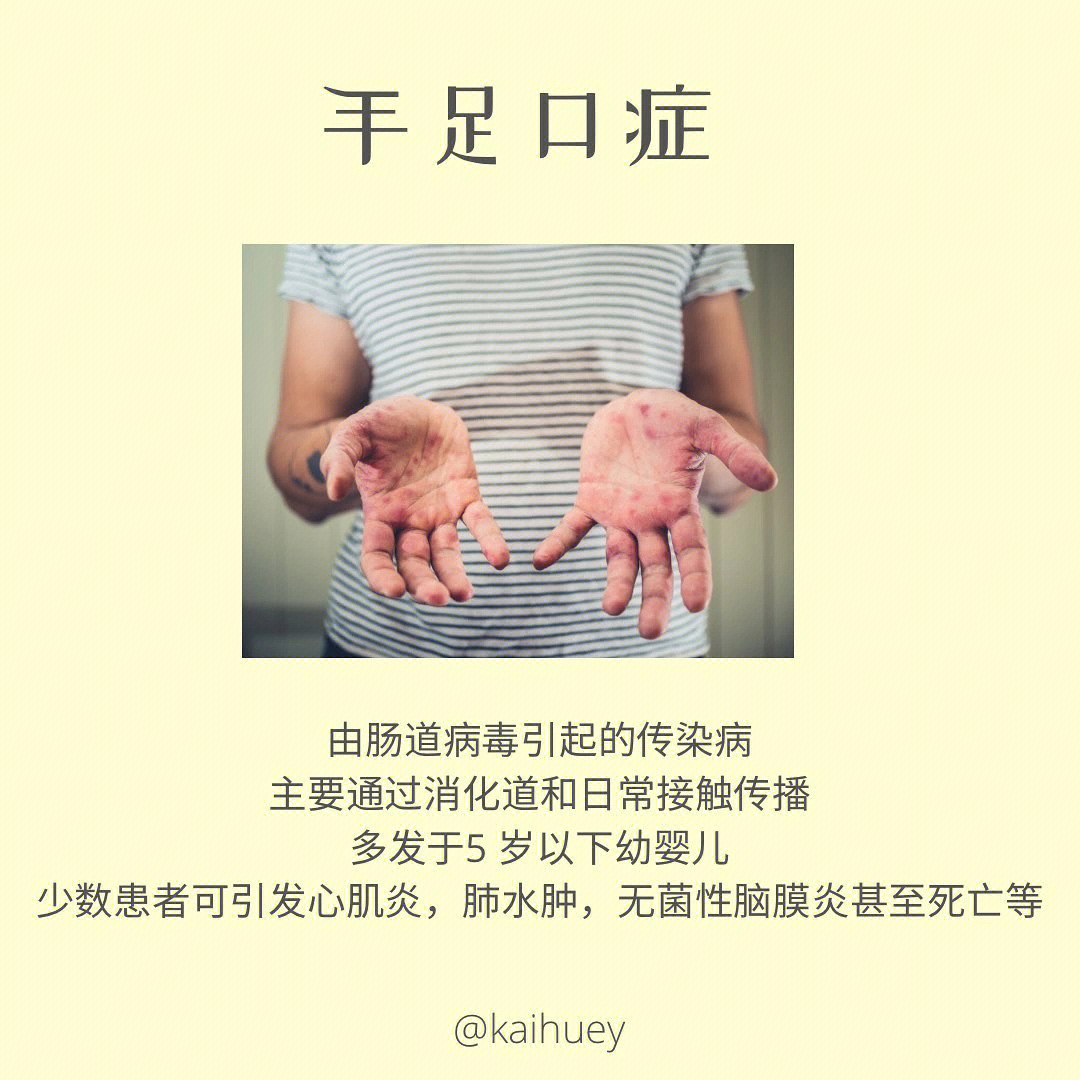 手足口病是什么引起的图片