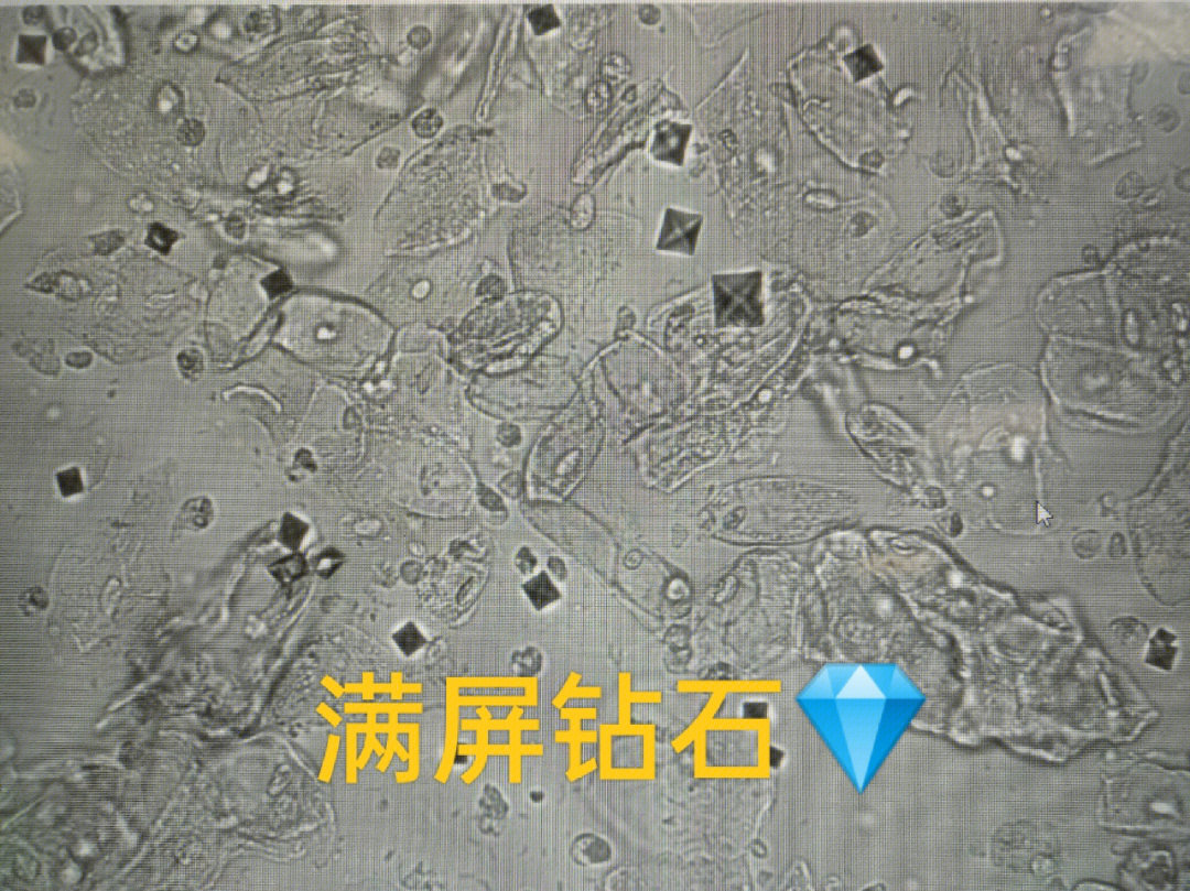 尿液磷酸钙结晶图片图片