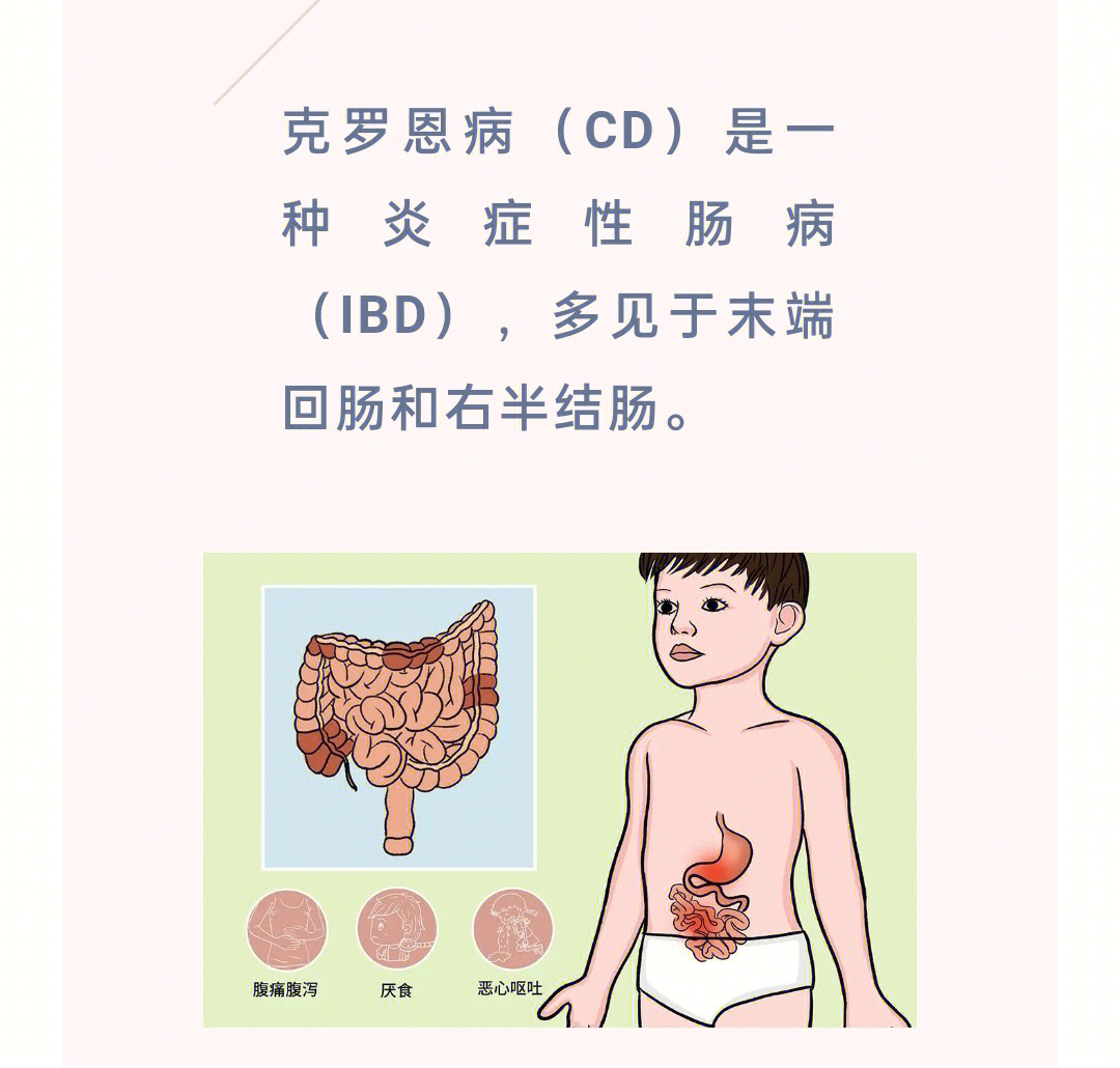 ③克罗恩"绿色癌症"早期易被误诊