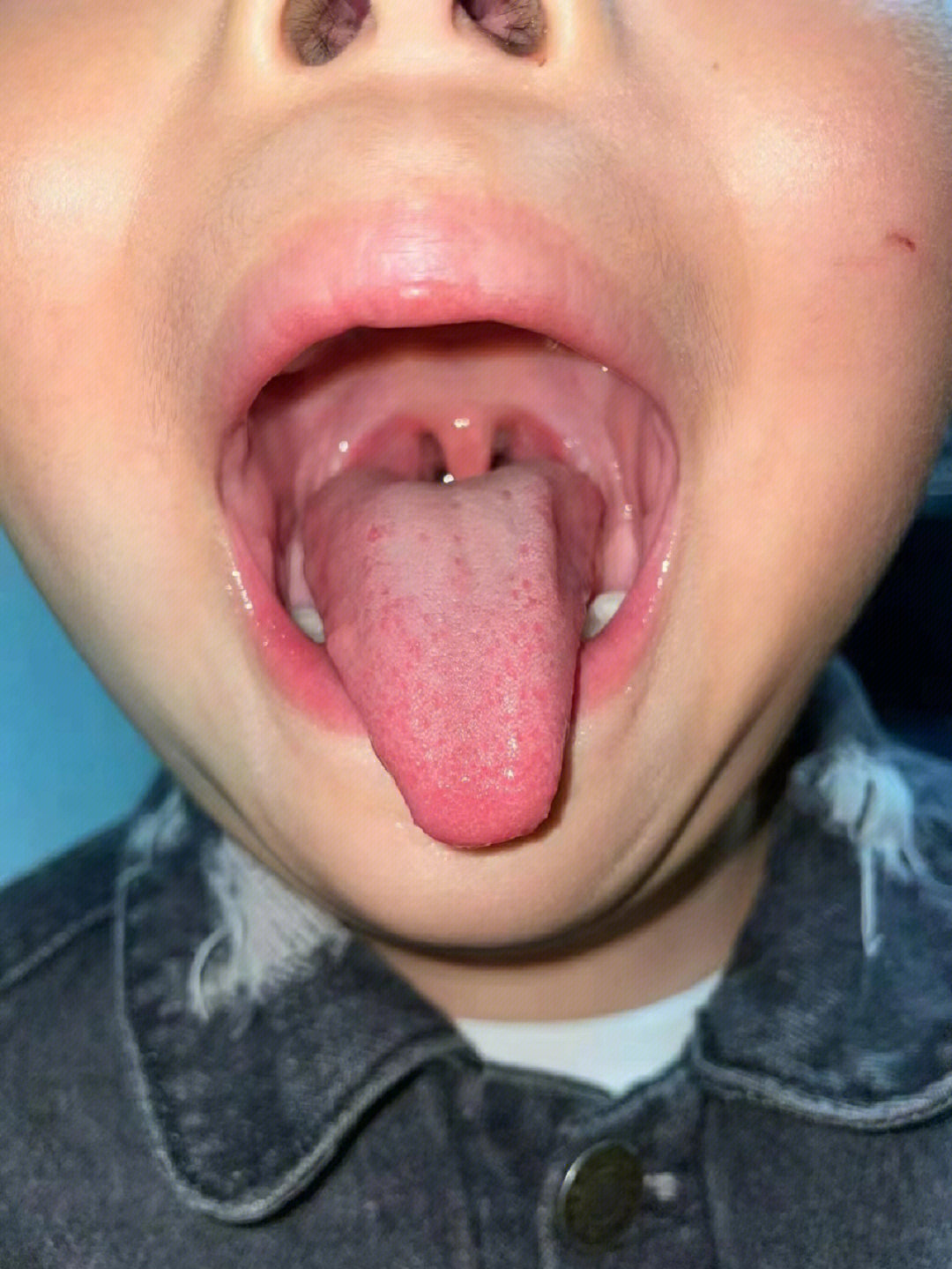舌头下面有血丝图片图片