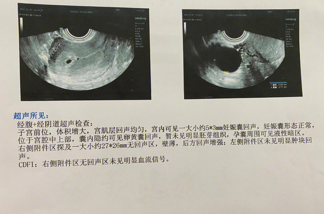 宫腔偏右侧图片