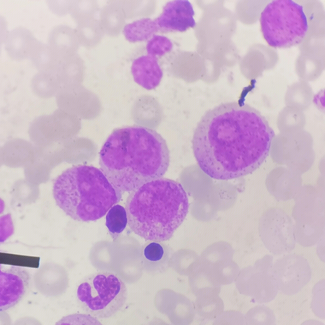 血液学检验急性髓细胞白血病m2a型