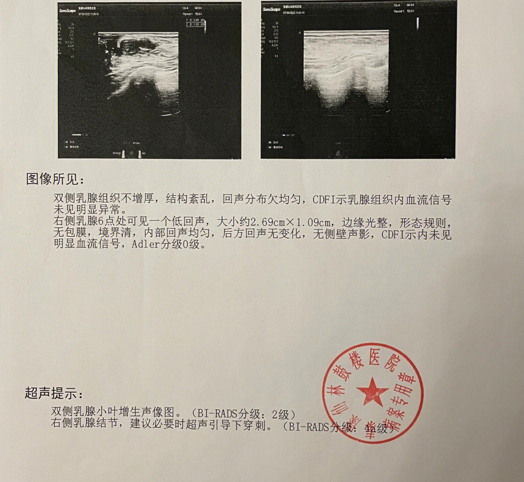 分叶状乳腺结节图片