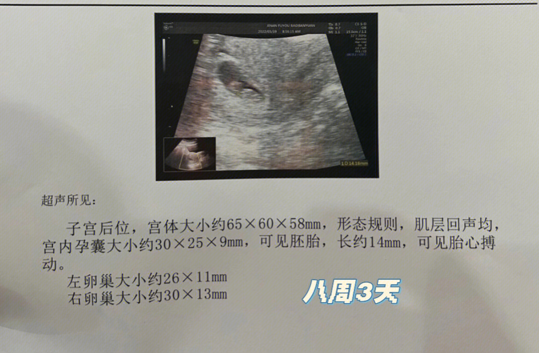 8周男孩胎囊图片图片