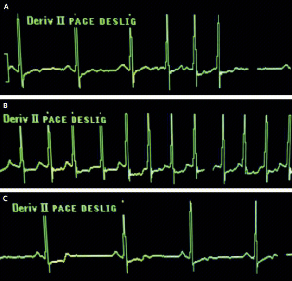 心律不齐subside   恢复,回落transthoracic echocardiography经胸