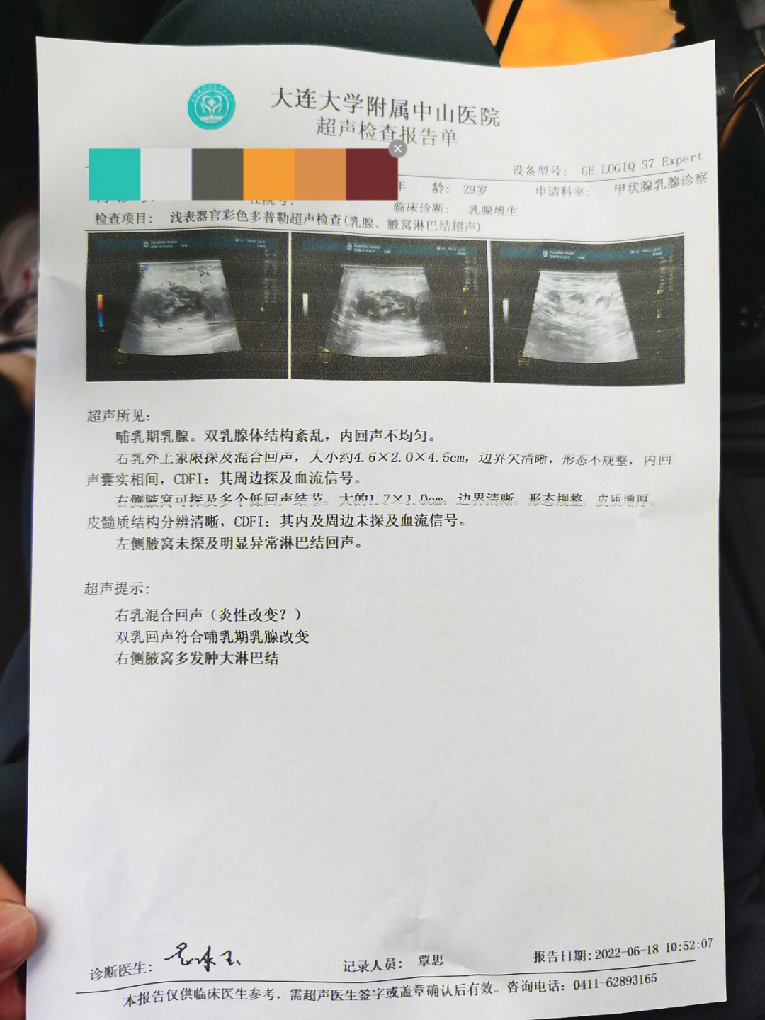 乳腺囊肿超声图片报告图片