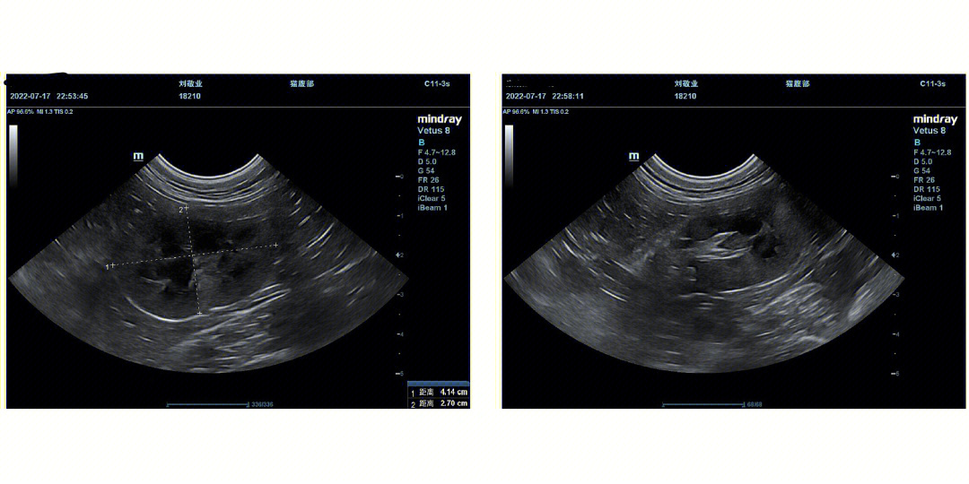 肾钙乳症超声图片