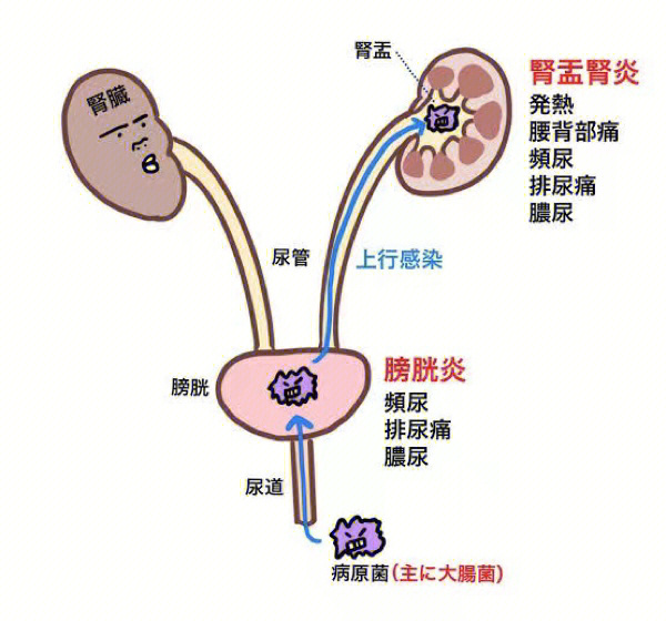 确诊了尿路感染,四个月男宝(日本)