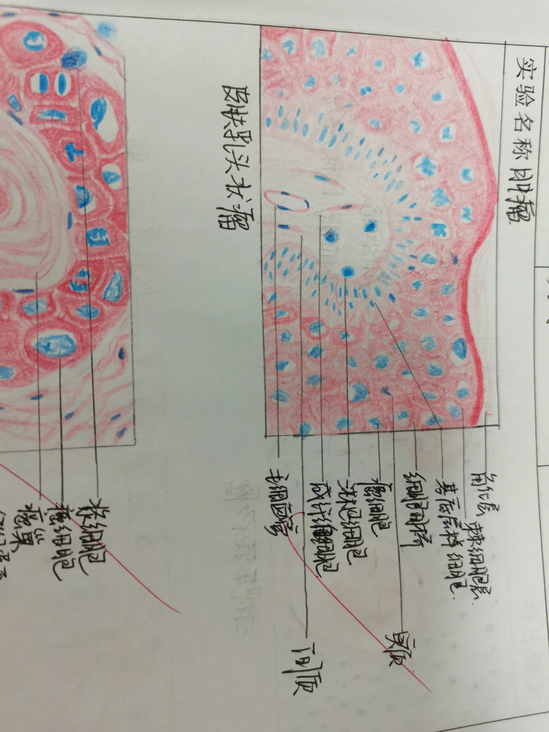 结肠腺癌红蓝绘图图片