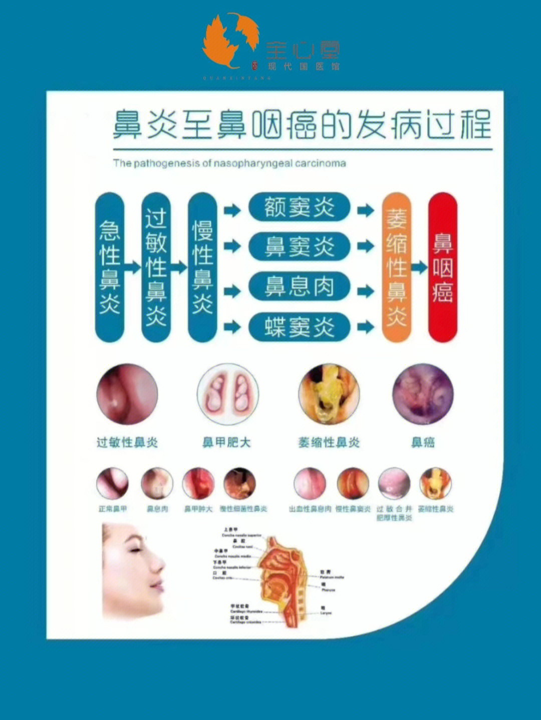 鼻窦炎和鼻炎区别图片