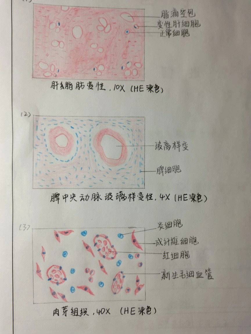 脾凝固性坏死手绘图图片