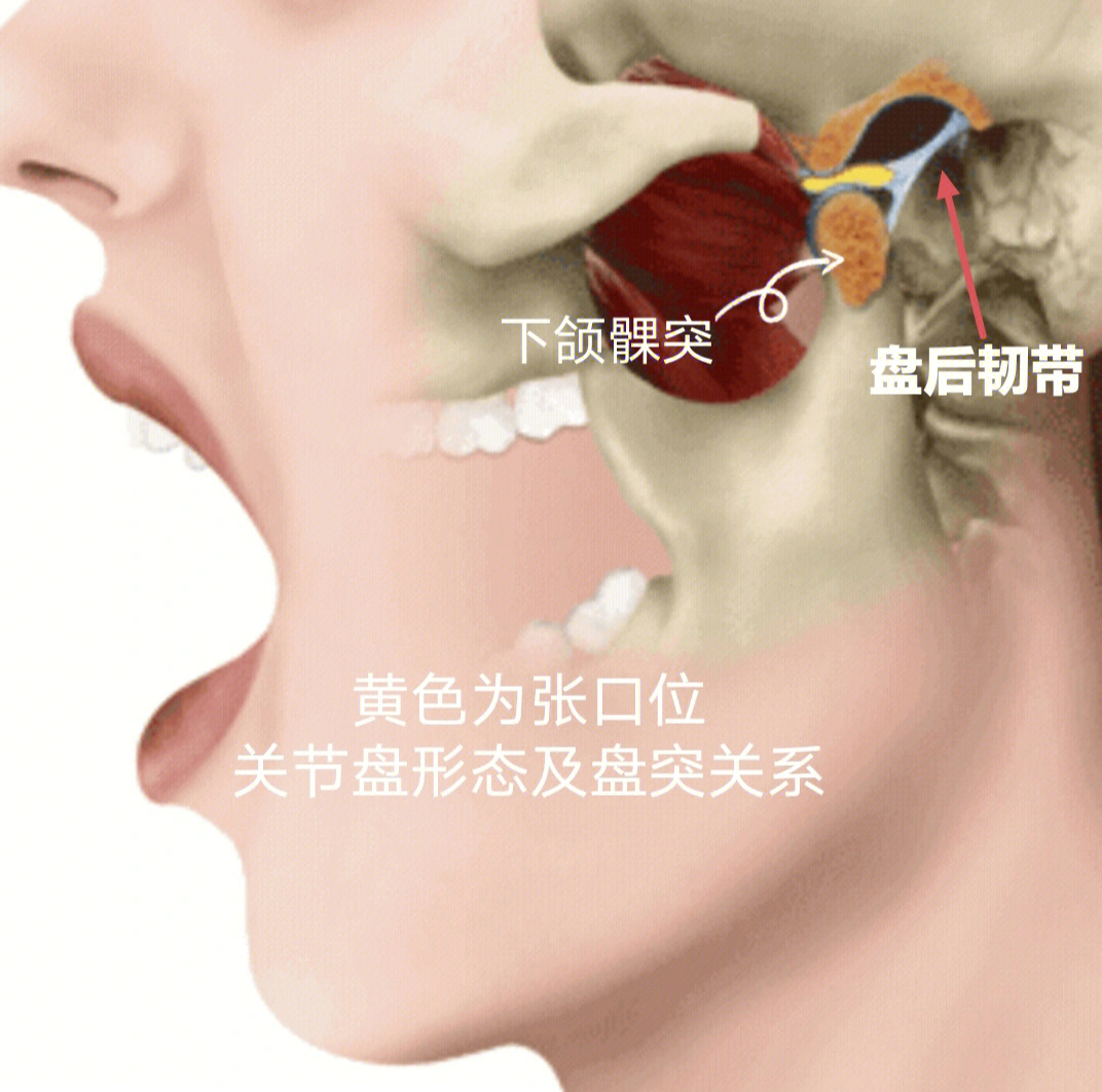 图1张口位关节盘(黄色)形态及关节盘与髁突位置关系图2闭口位关节盘