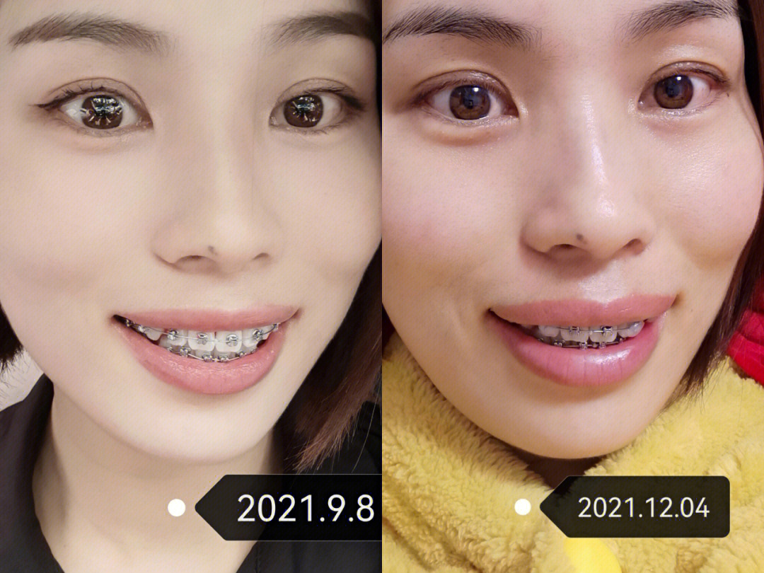 带牙套1~12月变化图图片