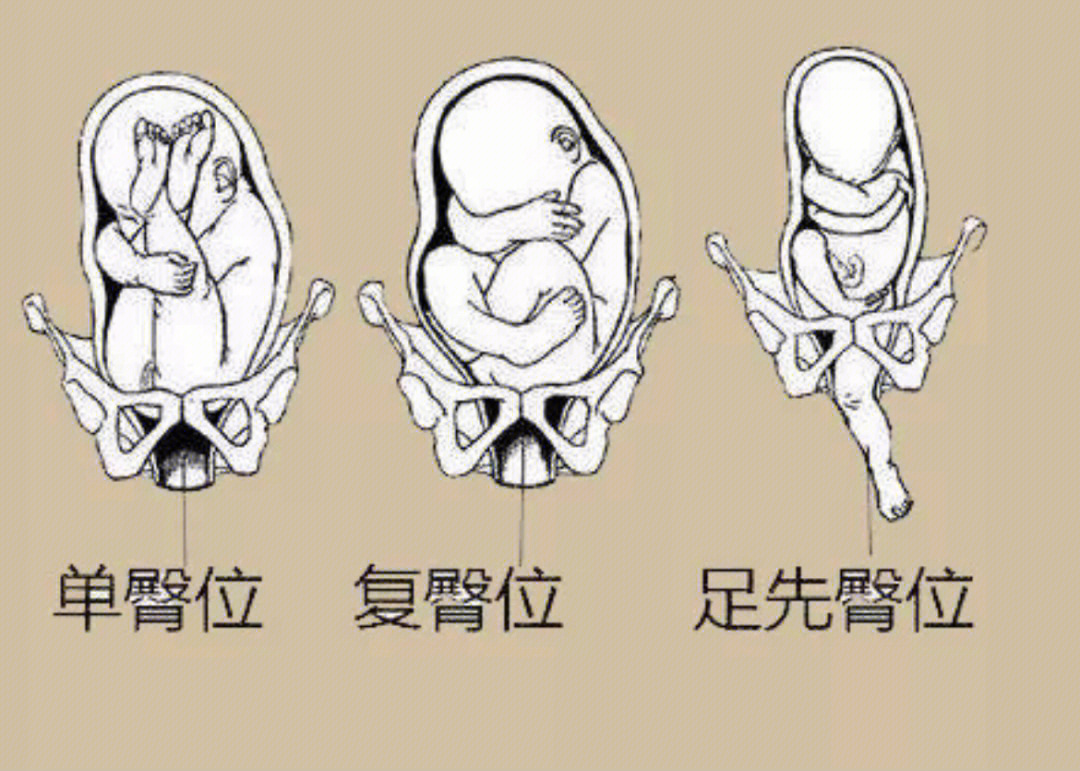 胎儿臀位转头位过程图图片