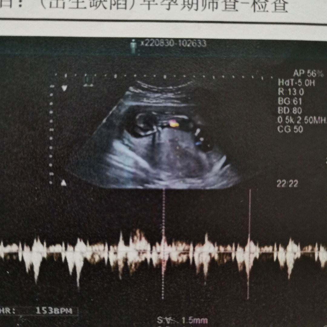 怀孕12周男女区别图图片