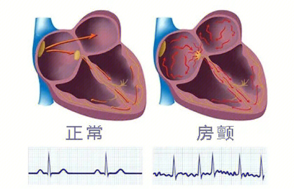 一张图告诉你什么叫房颤