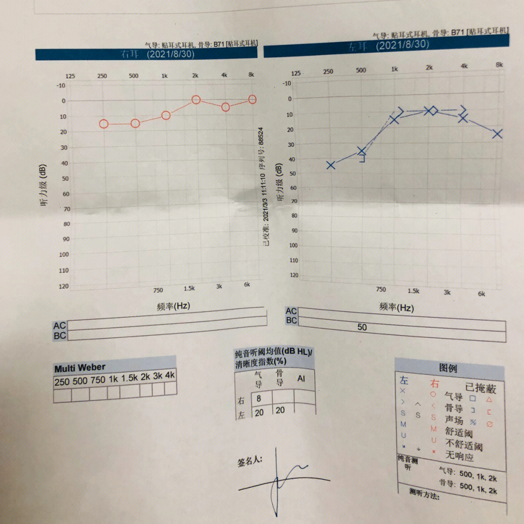 耳硬化症纯音测听图图片