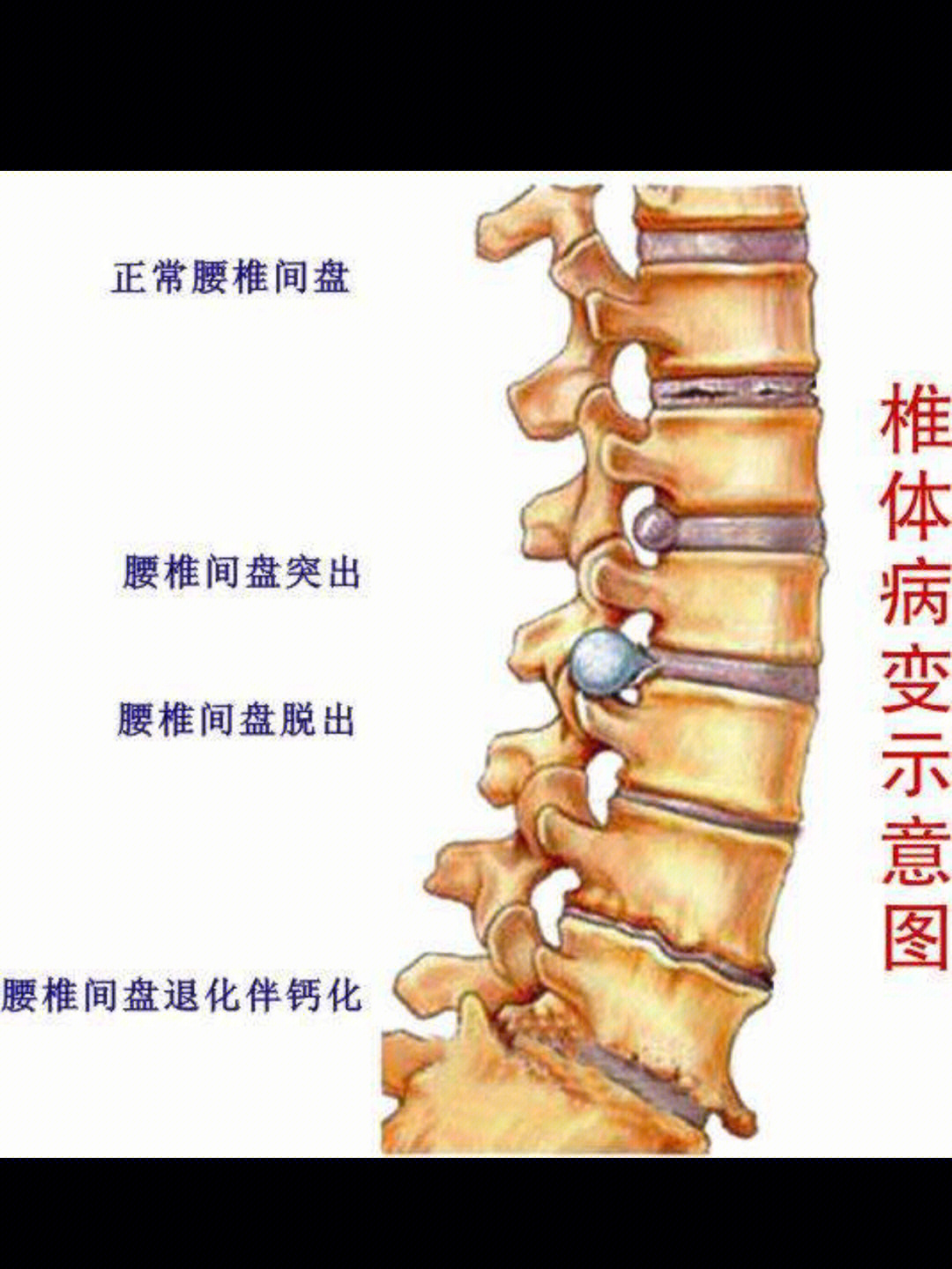 腰椎隐窝位置示意图图片