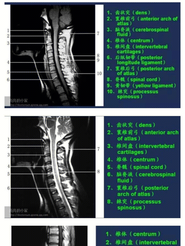 颈椎核磁图谱解析图片