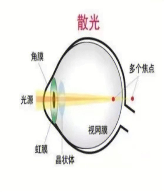 散光是咋回事儿