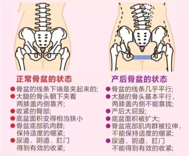 骨盆不正时周围疼痛感明显生完孩子,骨盆在用力过程中会被撑开胯骨被