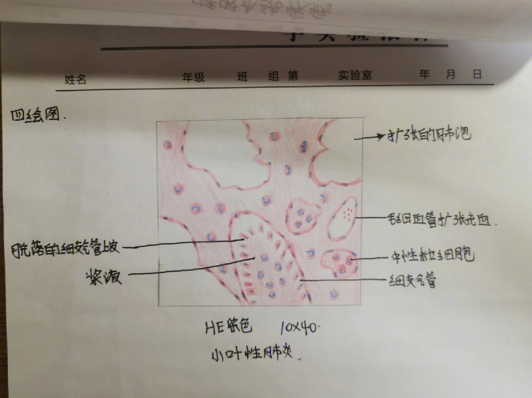 病理学红蓝铅笔绘图之小叶性肺炎
