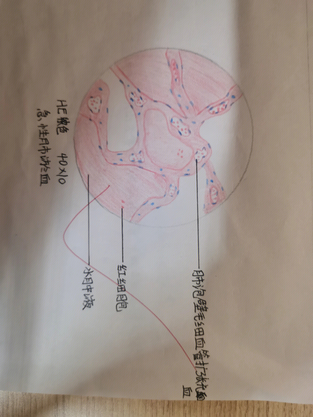 急性肺瘀血之病理红蓝铅笔手绘图