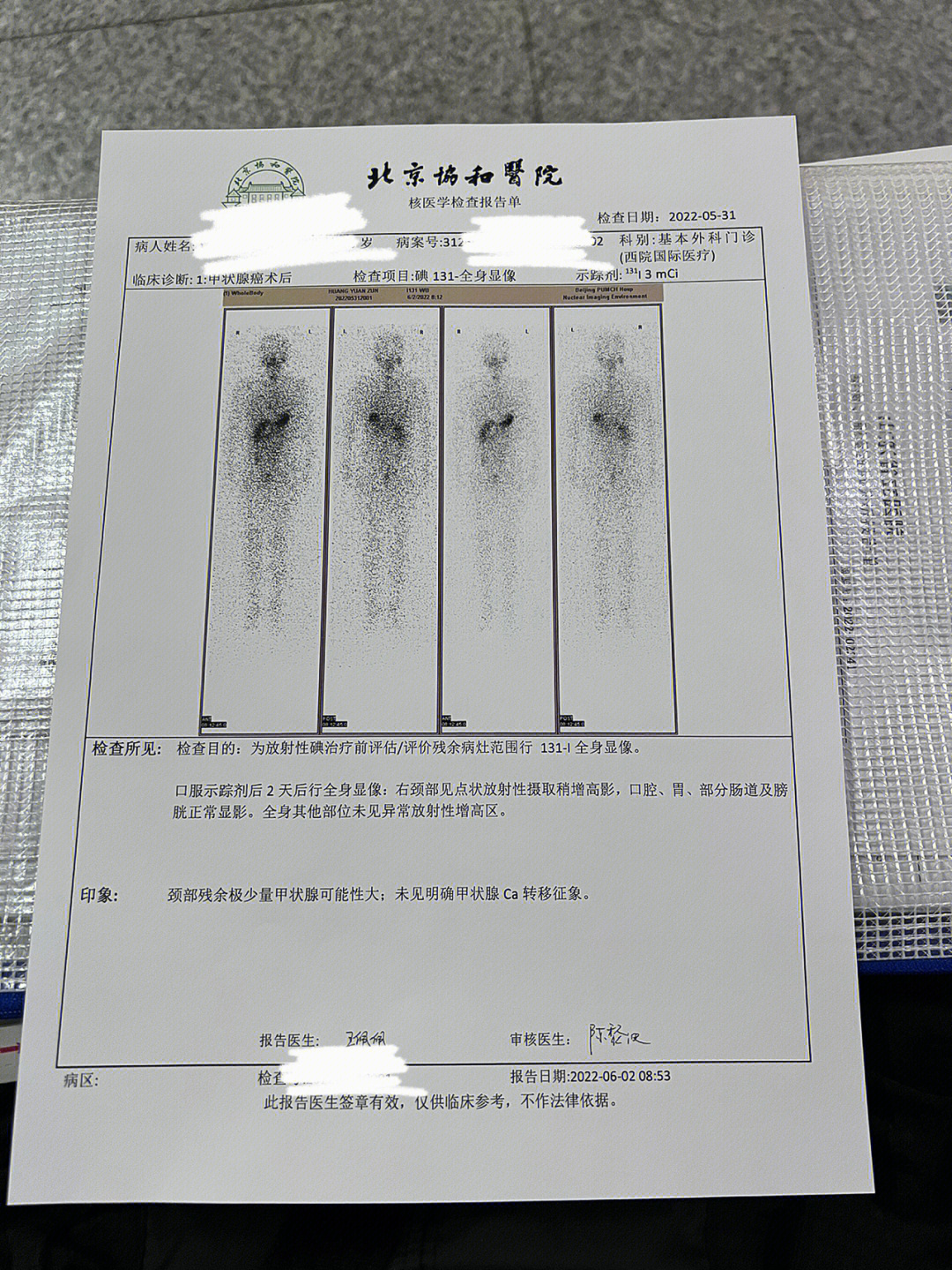 碘131全身显像正常图图片