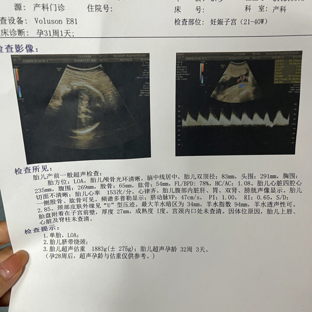 孕31周 1 b超显示胎儿偏大