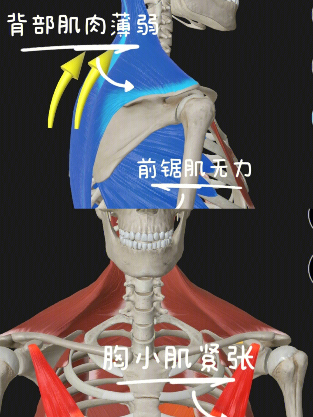 翼状肩胛手术图片