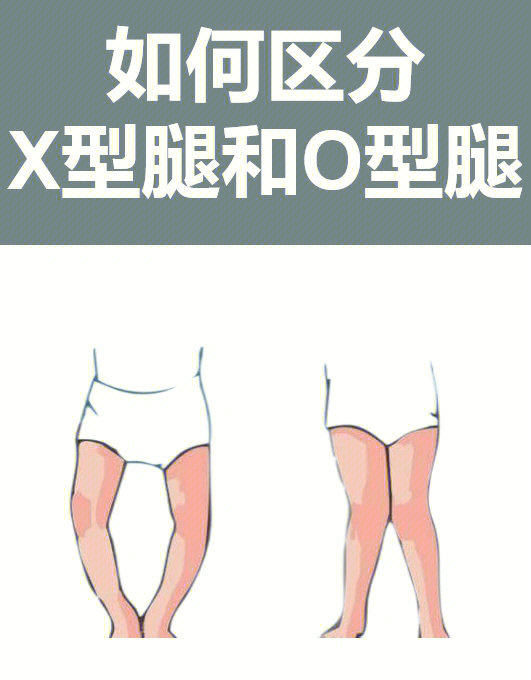 x型腿o型腿区别图解图片