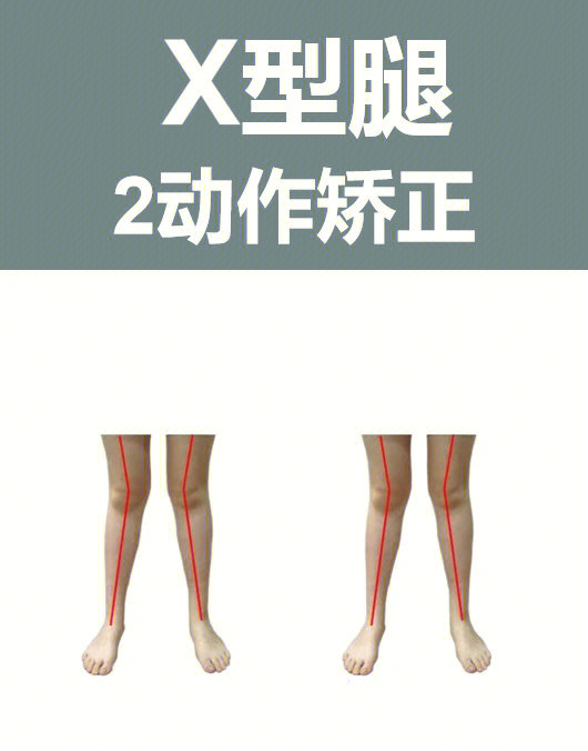 x型腿矫正方法图解图片