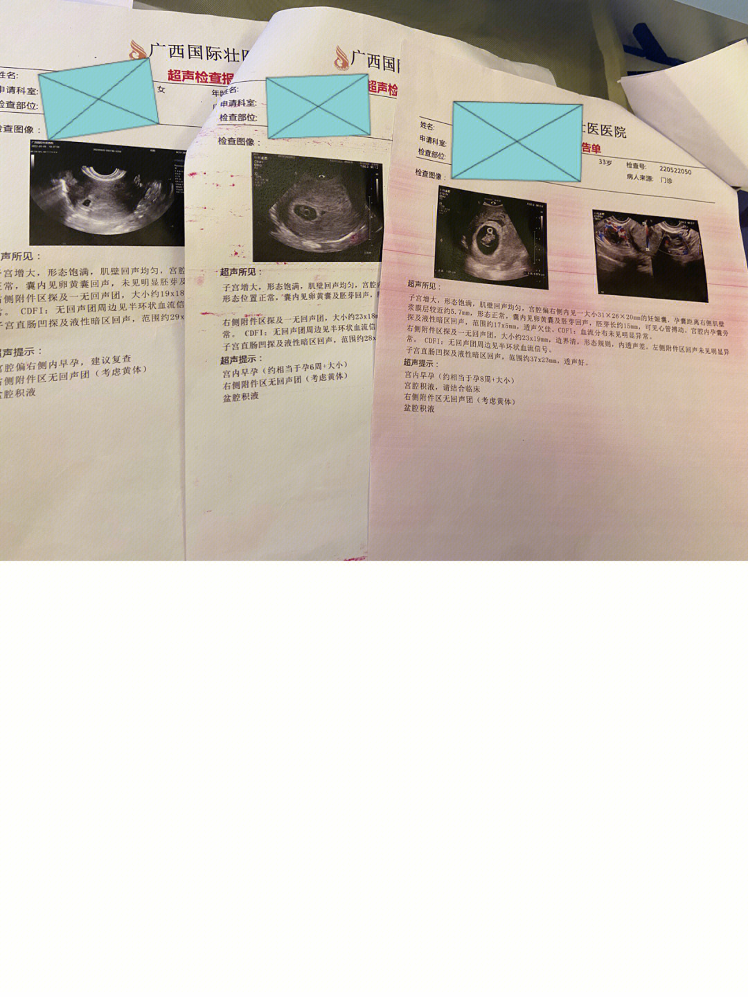 怀孕早期妊娠囊孕囊偏右宫角