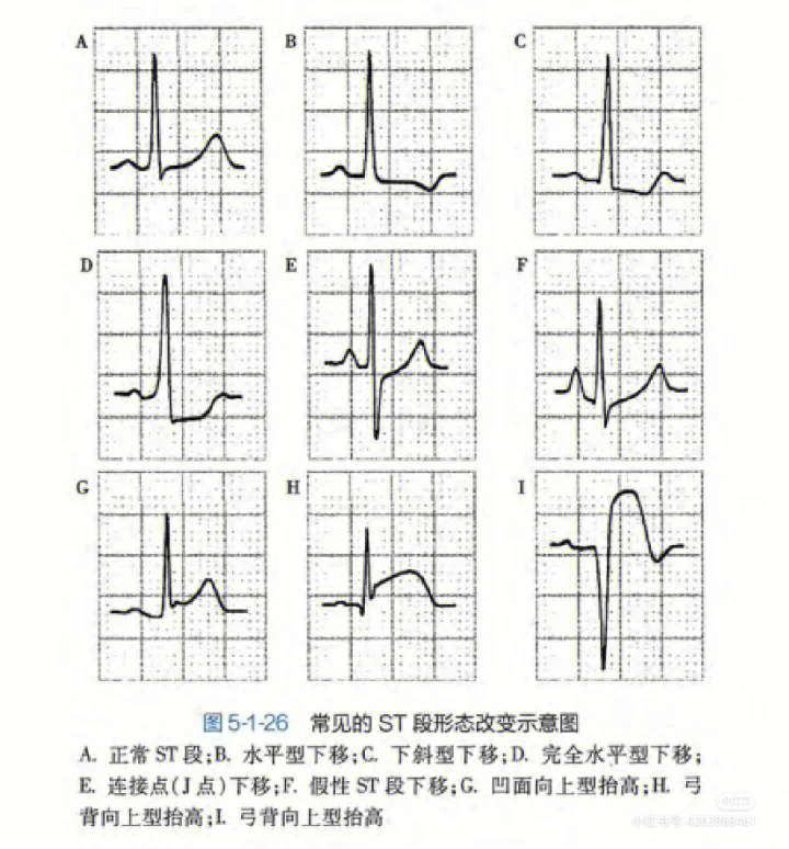 心电图等电位线是死了图片