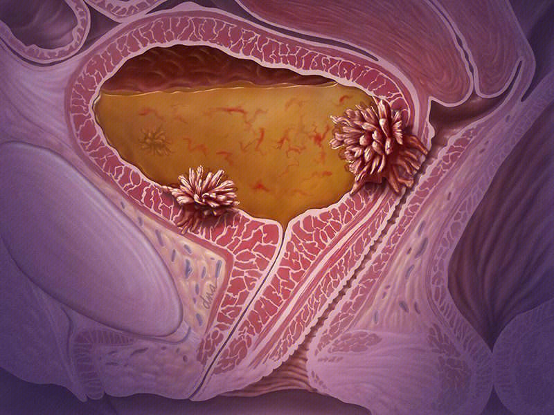 膀胱癌的早期症状图图片